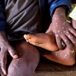 Africa CDC Mpox Health Emergency