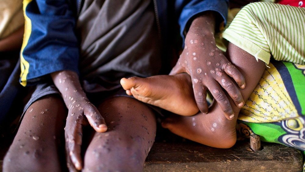 Africa CDC Mpox Health Emergency