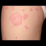 sexually transmitted ringworm