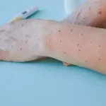 Mpox Cases Children NCDC