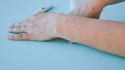 Mpox Cases Children NCDC