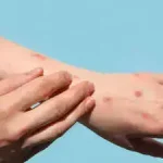 Ghana First Case Mpox