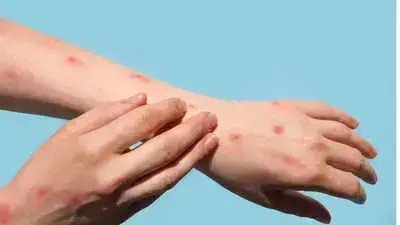 Ghana First Case Mpox